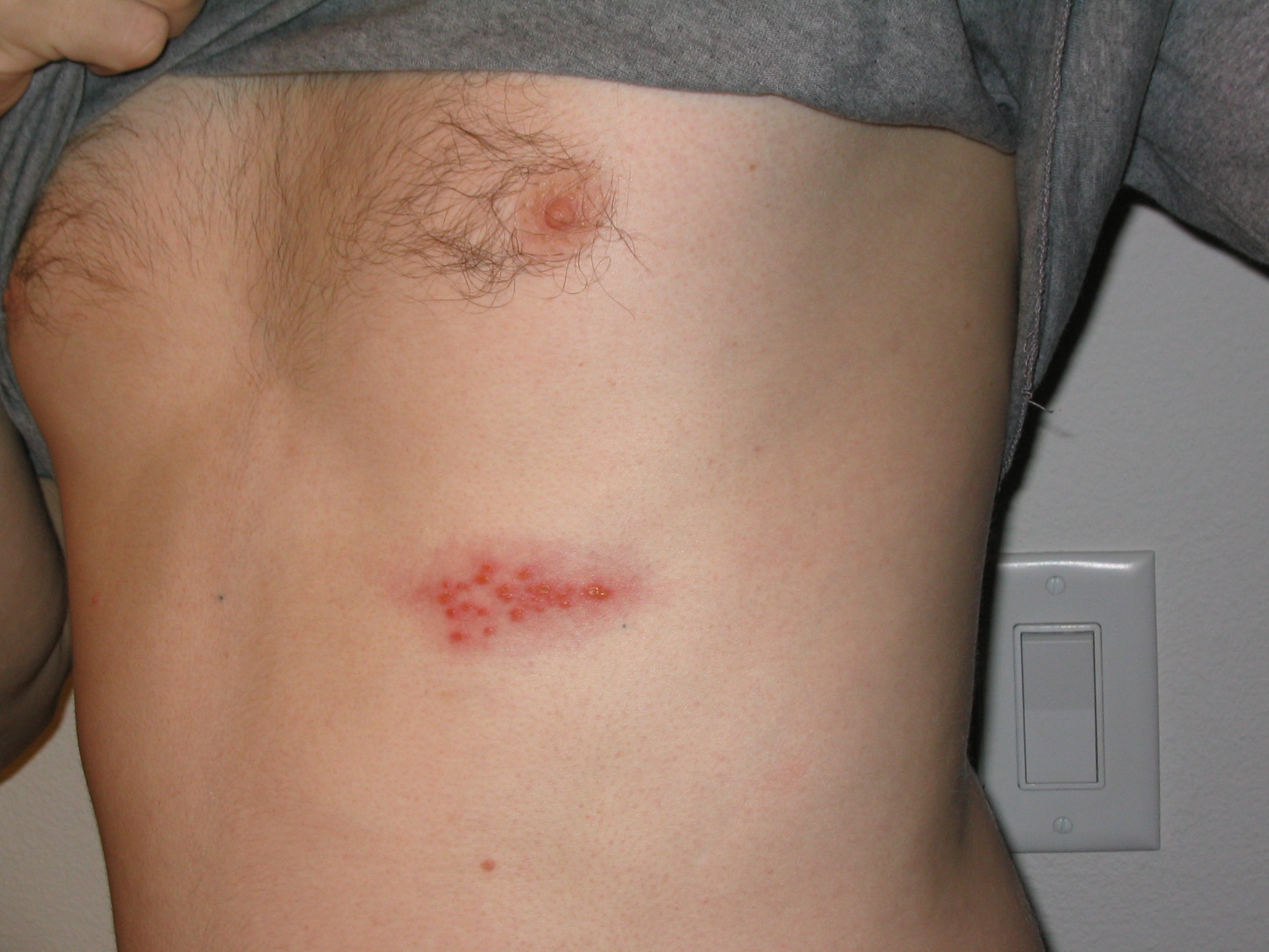‘Take shingles seriously’ Gesy urges public