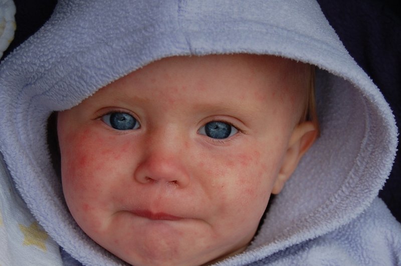 image Hospital director urges vaccination as measles rises in Europe