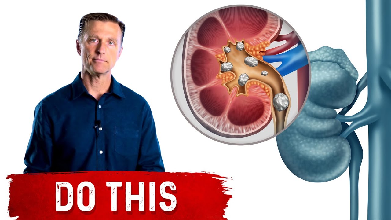image What to do at the first sign you have kidney stones