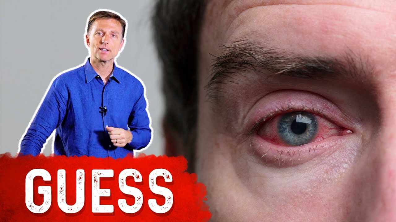 image The vitamin deficiency that can cause bloodshot eyes