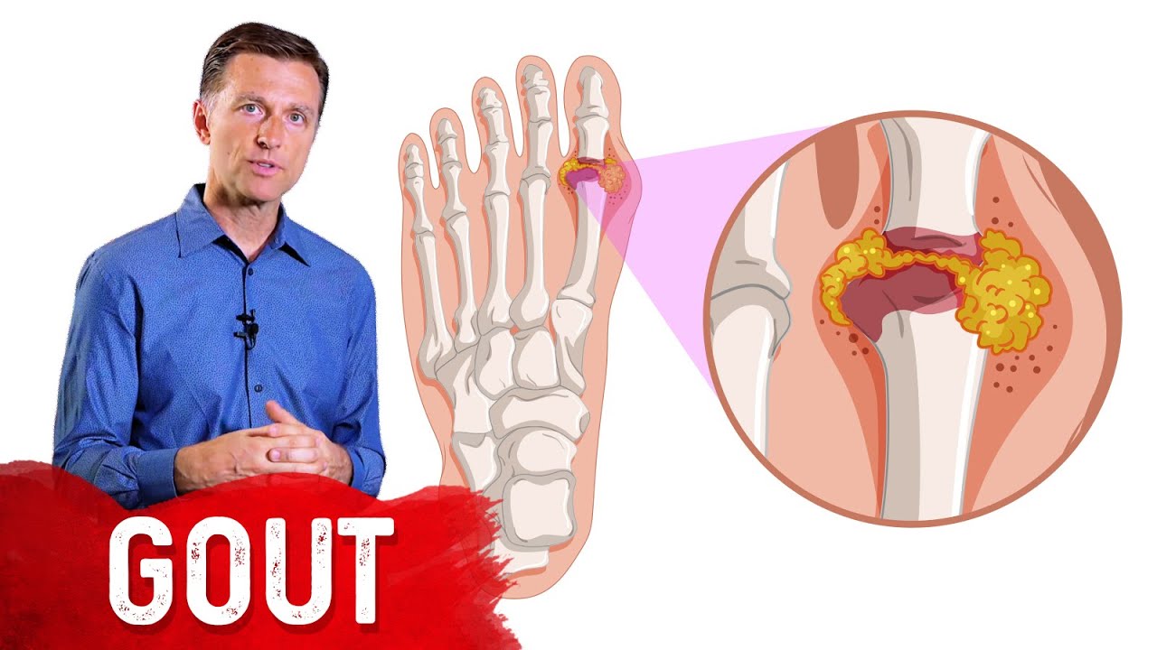 image Seven natural remedies to relieve gout
