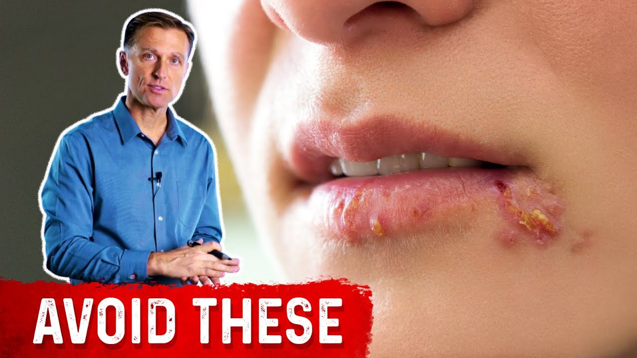image Avoid these foods if you have herpes