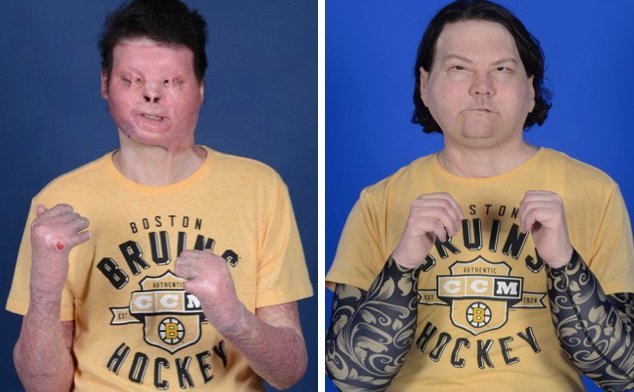 image Lucky to be alive, owner of new face, hands learns to feel life anew