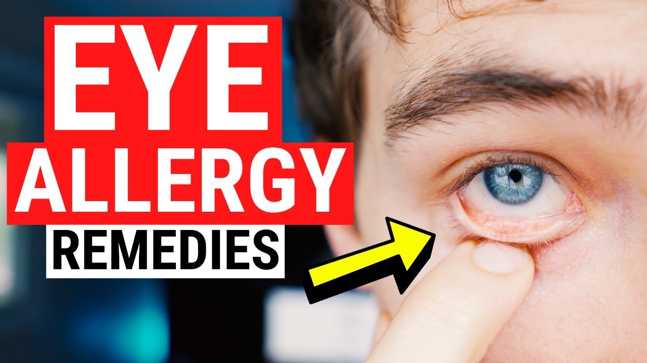 image Eye allergy remedies &#8211; tips for itchy and watery eyes