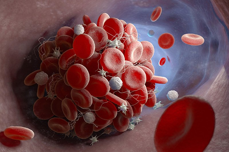 image Worried about blood clots? Here’s what you need to know