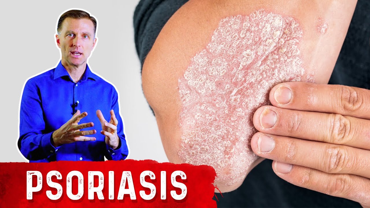image Three natural remedies to try against psoriasis