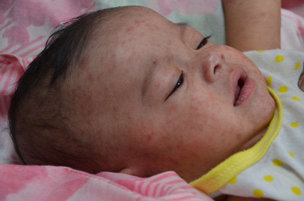 image CDC says Delta variant as contagious as chickenpox