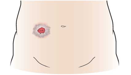 image Pasykaf supports patients with stoma