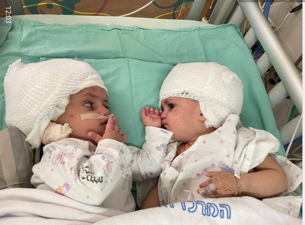 image Born conjoined back-to-back, Israeli twins finally see each other after surgery