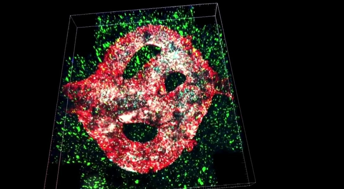 image Cancer patients’ own cells used in 3D printed tumours to test treatments