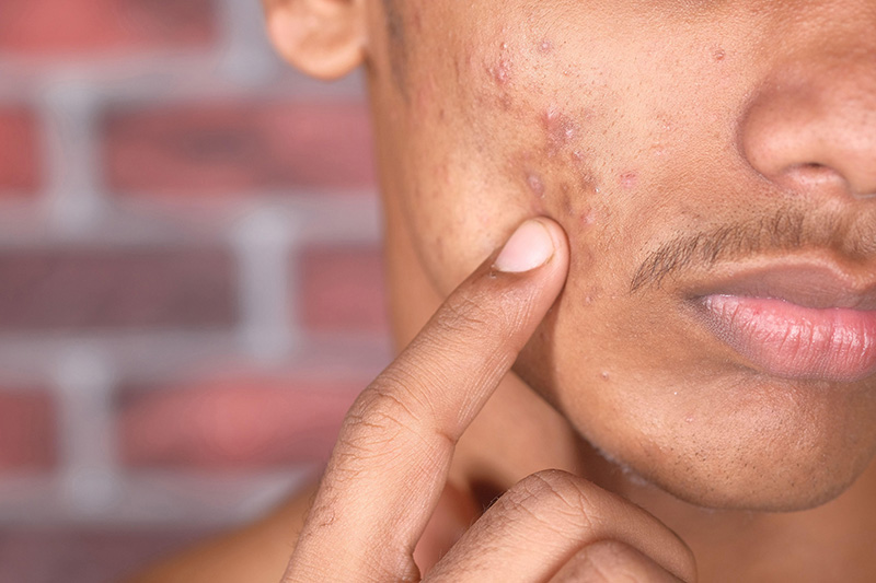 image Acne myths debunked by a dermatologist