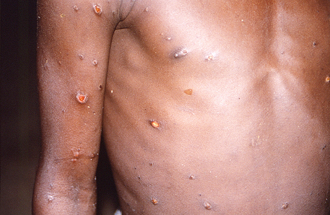 image Cuba confirms first monkeypox case in visitor from Italy