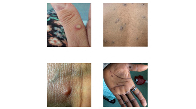 image Spain and Brazil report first monkeypox deaths outside Africa in current outbreak