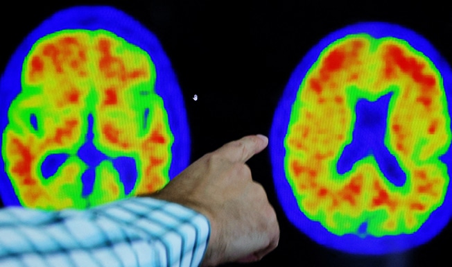 image US FDA delays Lilly Alzheimer&#8217;s drug decision, calls for advisory panel