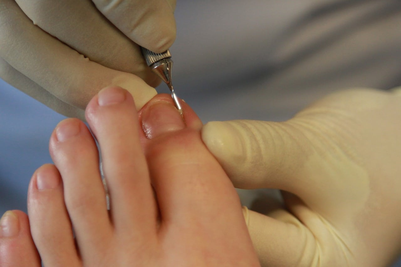 image Podiatrists celebrate Gesy inclusion