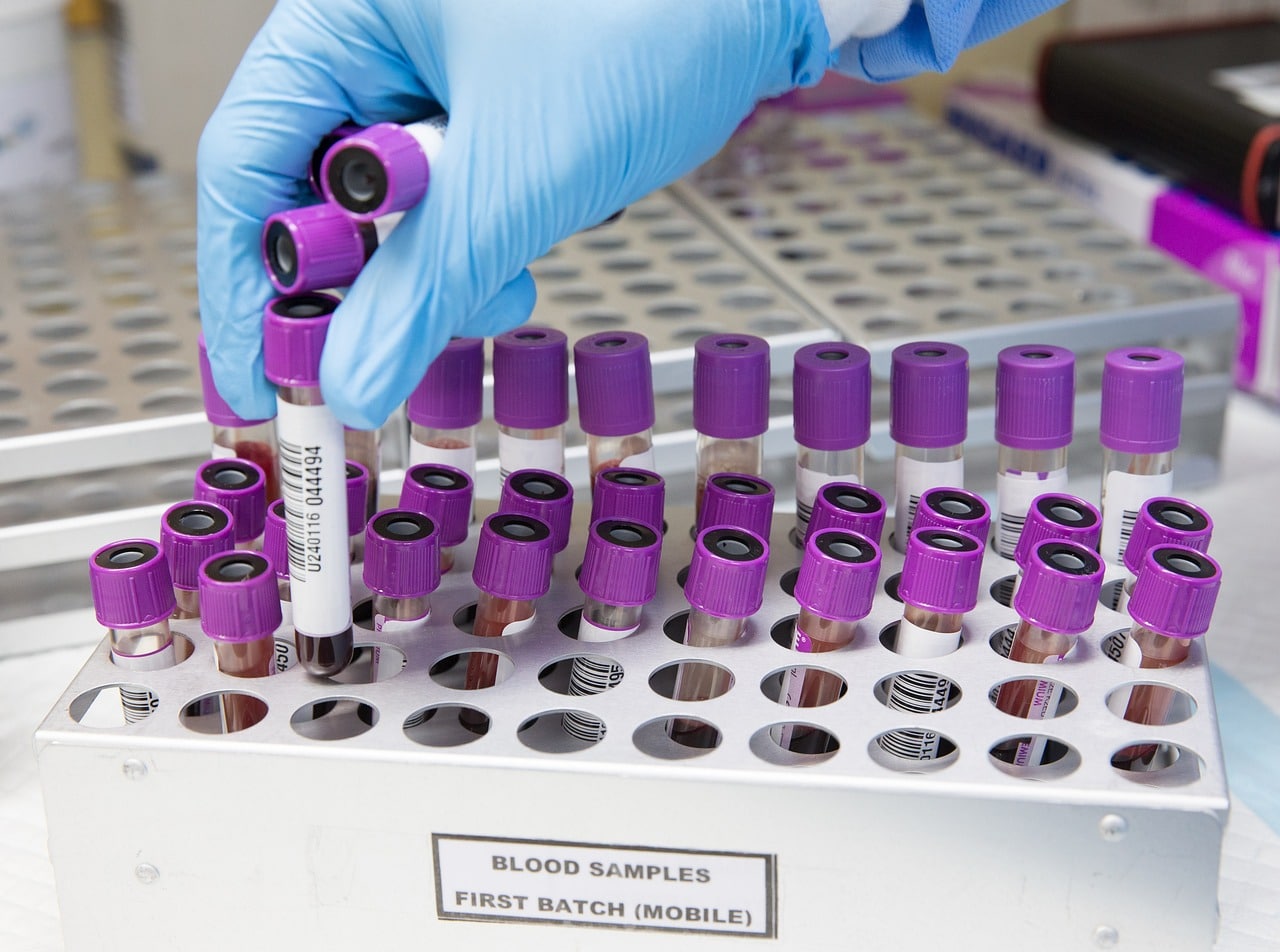 image ‘Around 1,400 Cypriots have haemoglobin disorders’