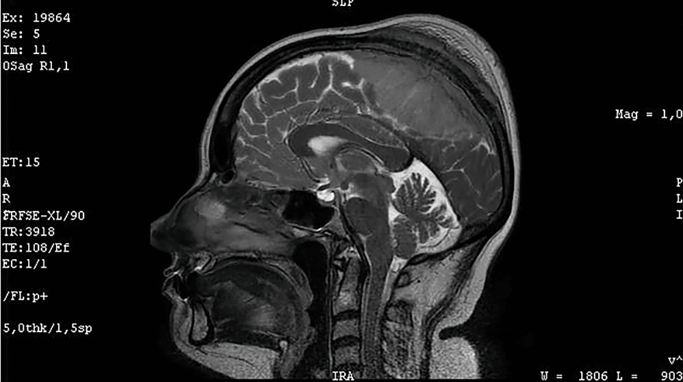 image The hidden truth behind Meningioma: A comprehensive guide