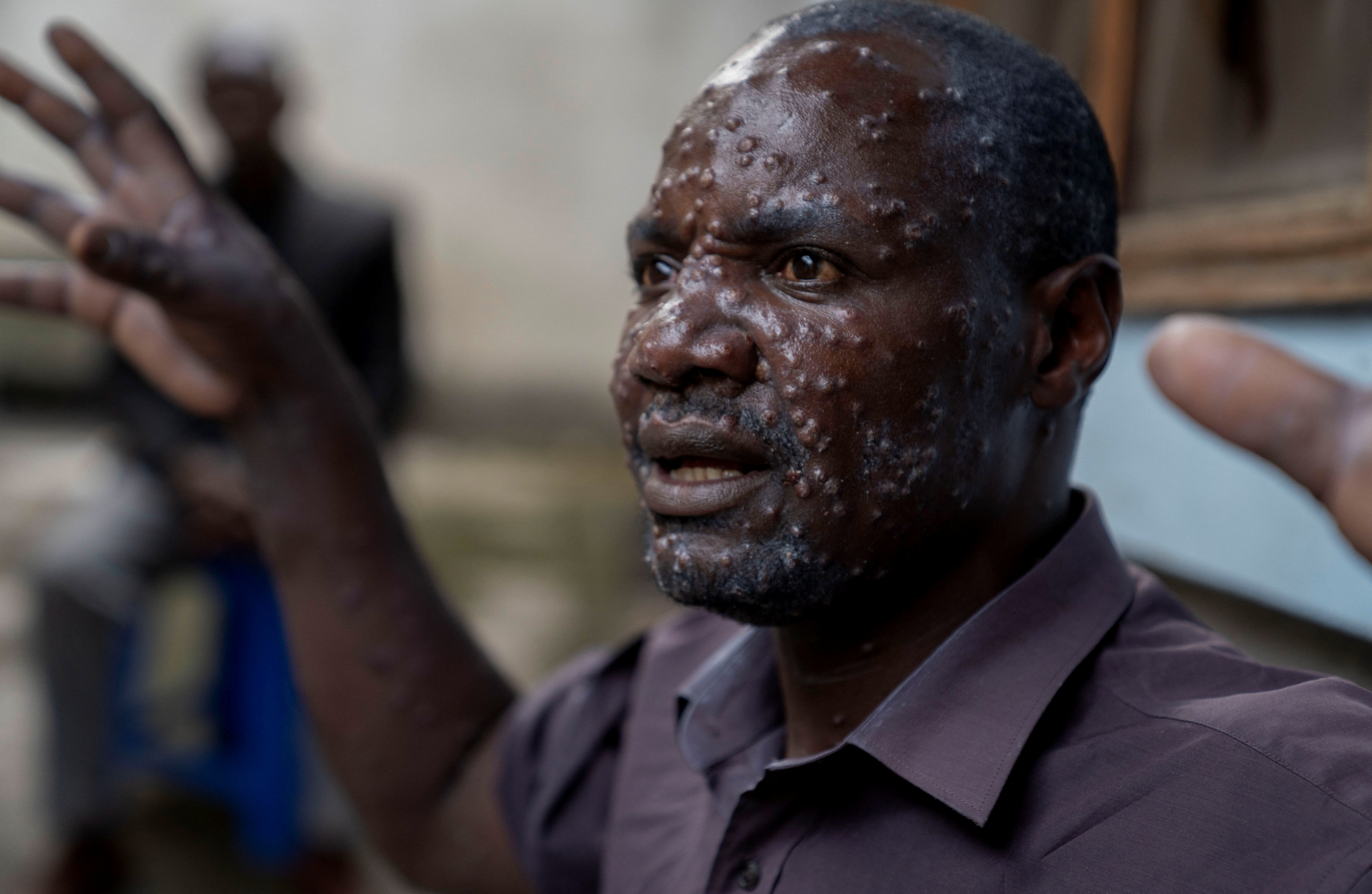 image WHO to convene emergency committee on mpox outbreak in Congo