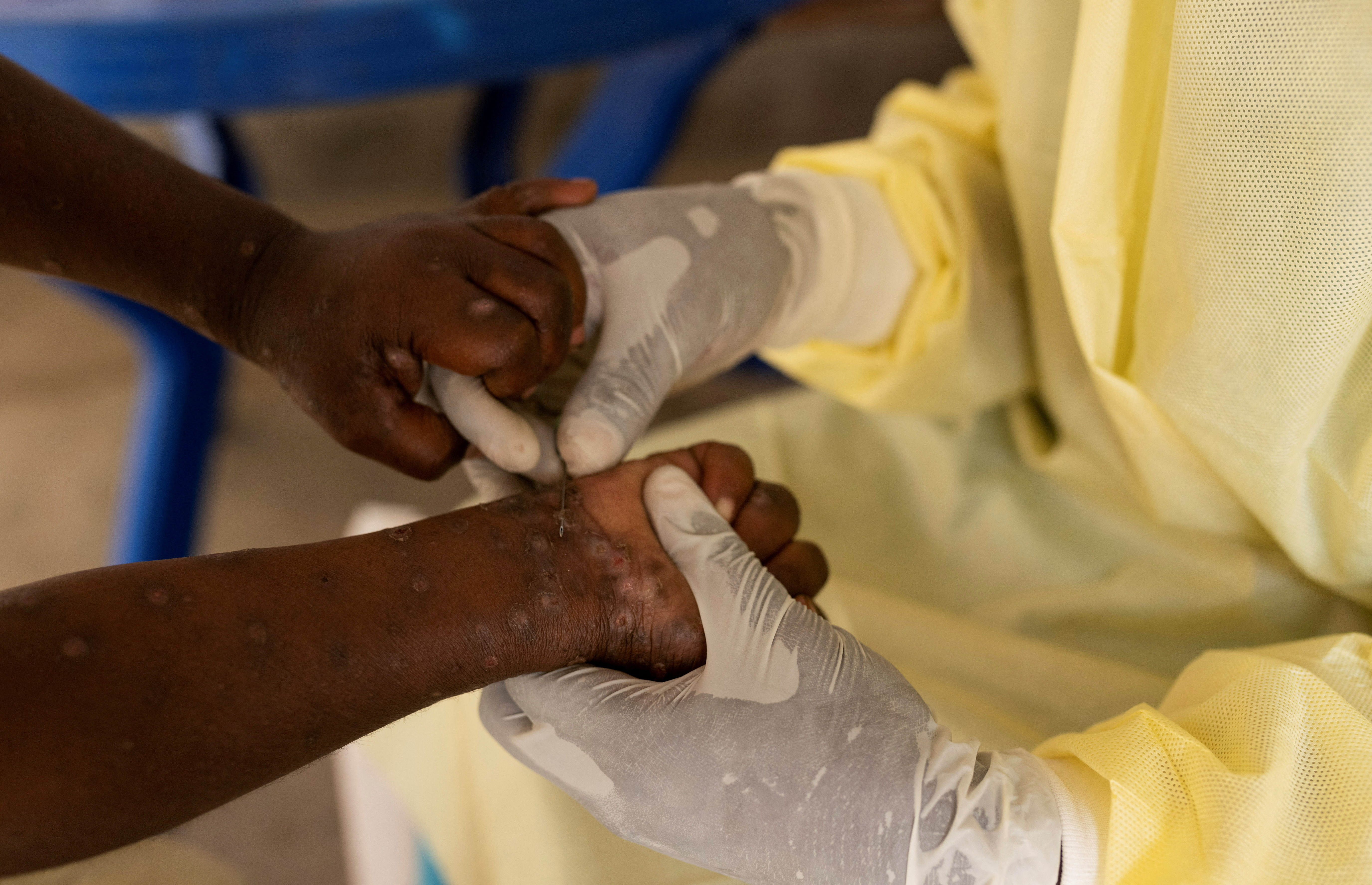 image WHO declares mpox a global public health emergency for second time in two years