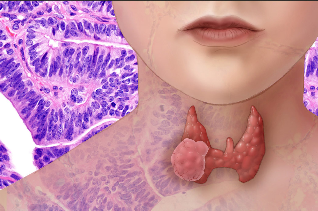 image Thyroid cancer awareness campaign kicks off