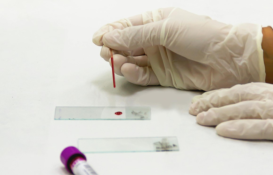 image A simple blood test could change how Alzheimer’s is diagnosed