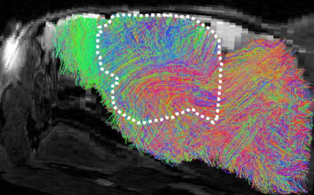 cover Scientists transplant lab-grown human brain tissue into mice